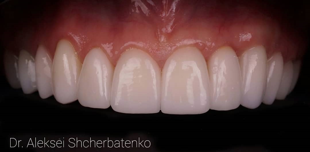 After-Dental2